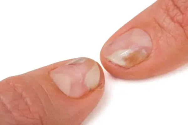 ciuperca unghiilor cu gel pe maini