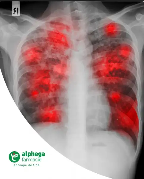 Tuberculoza – flagelul care ameninţă din nou lumea