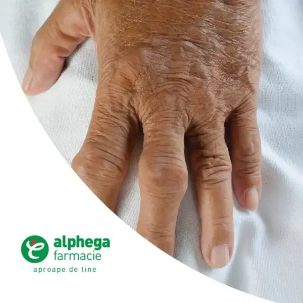 inflamația articulațiilor degetelor unguent tratament